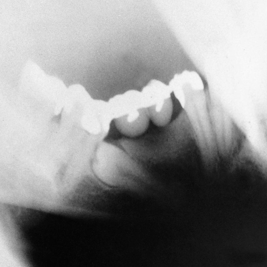 Fig. 10.9, Impacted tooth under a fixed bridge. The tooth must be removed and therefore may jeopardize the bridge.