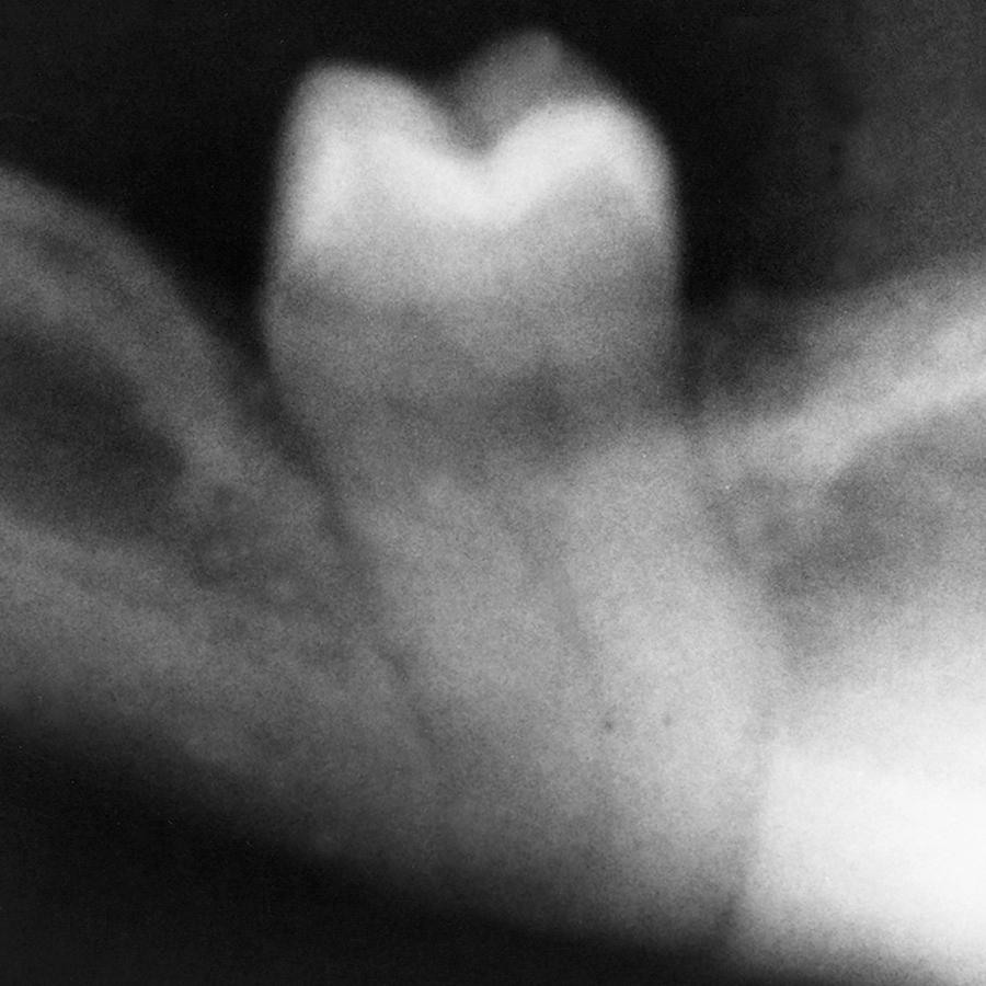 Fig. 10.10, Impaction in an atrophic mandible, which may result in jaw fracture during extraction.