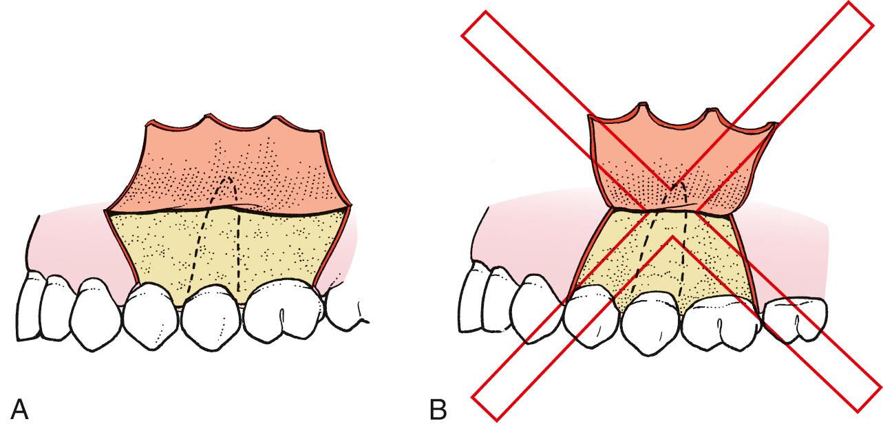 Fig. 9.1, (A) The flap must have a base that is broader than the free gingival margin. (B) If the flap is too narrow at its base, blood supply may be inadequate, which can lead to flap necrosis.