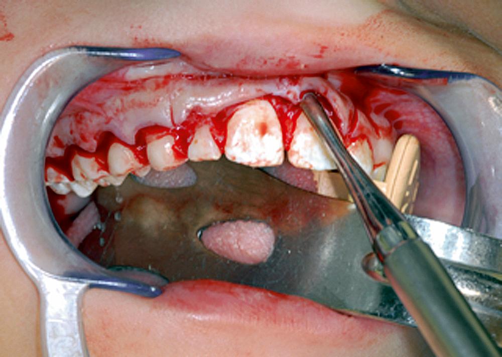 Fig. 9.12, The reflection of the flap is begun by using the sharp end of the periosteal elevator to pry away the interdental papilla.