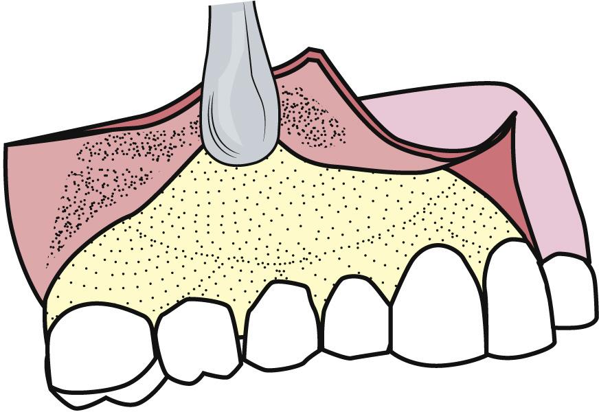 Fig. 9.13, When a three-cornered flap is used, only the anterior papilla is reflected with the sharp end of the elevator. The broad end is then used with a push stroke to elevate posterosuperiorly.