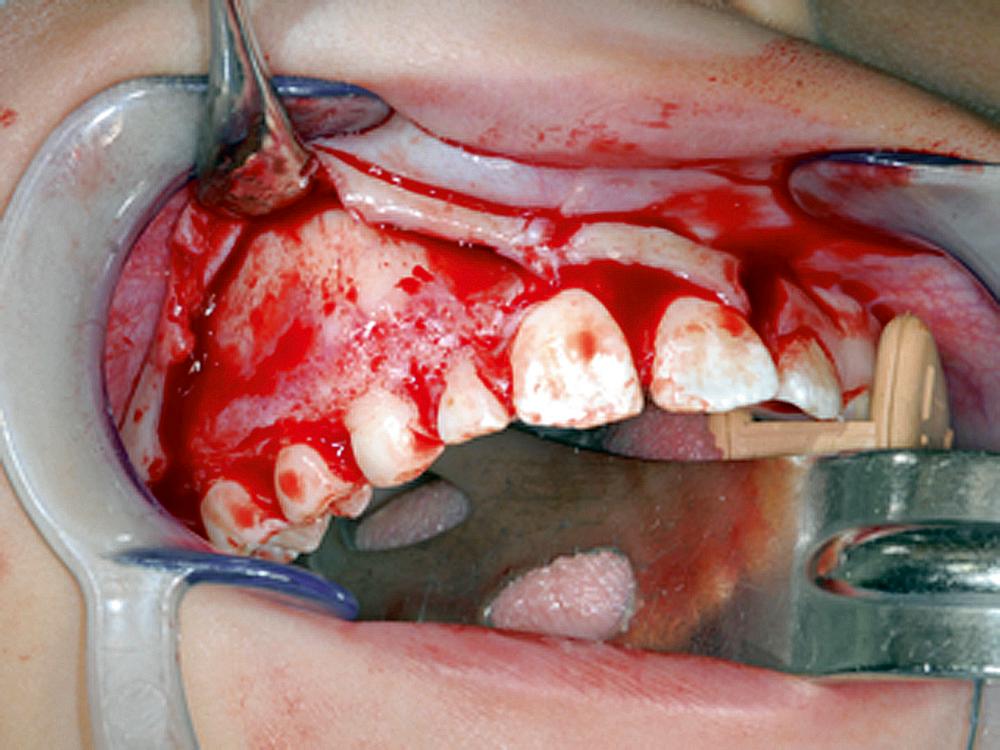 Fig. 9.14, A periosteal elevator is used to retract the mucoperiosteal flap. The elevator is placed perpendicular to the bone and held in place by pressing firmly against the bone, not by pushing it apically against soft tissue. Notice the vertical releasing incision located at the distal line angle of tooth #9.