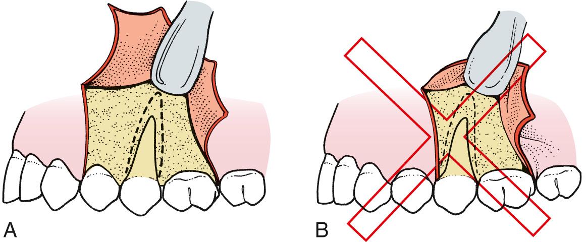 Fig. 9.3, (A) When designing a flap, it is necessary to anticipate how much bone will be removed so that after surgery is completed, the incision rests over sound bone. In this situation, the vertical release was one tooth anterior to bone removal, and left an adequate margin of sound bone. (B) When a releasing incision is made too close to bone removal, delayed healing results.