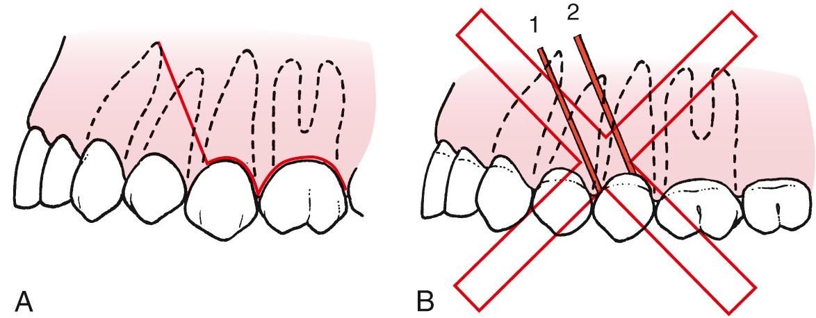 Fig. 9.4, (A) The correct position for the end of the vertical-releasing incision is at the line angle (mesiobuccal angle in this figure) of the tooth. Likewise, the incision does not cross the canine eminence. Crossing such bony prominences results in increased chance for wound dehiscence. (B) These two incisions are made incorrectly. (1) The incision crosses the prominence over the canine tooth, which increases the risk of delayed healing; the incision through the papilla results in unnecessary damage. (2) The incision crosses the attached gingiva directly over the facial aspect of the tooth, which is likely to result in soft tissue defect as well as periodontal and aesthetic deformities.