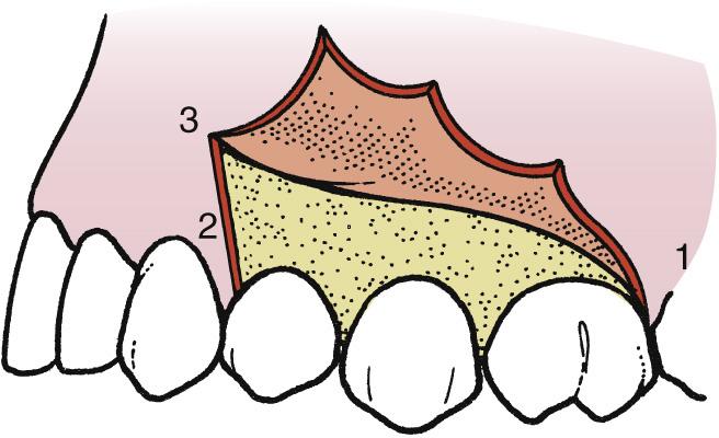 Fig. 9.5, The vertical-releasing incision converts the envelope incision into a three-cornered flap (corners numbered).