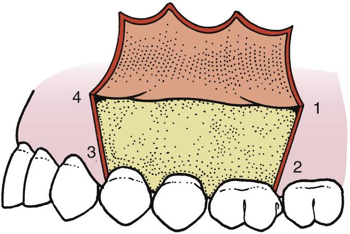 Fig. 9.6, Vertical-releasing incisions at the other end of the envelope incision convert the envelope incision into a four-cornered flap (corners numbered).