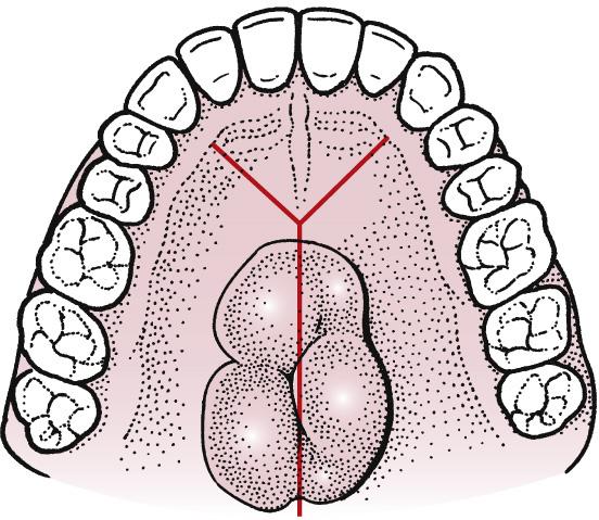 Fig. 9.8, The Y-incision is useful on the palate for adequate access to remove a palatal torus. Two anterior limbs serve as releasing incisions to provide for greater access.