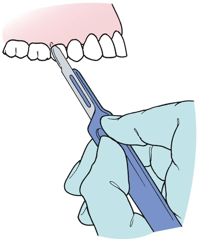 Fig. 9.10, A No. 15 blade is used to incise the gingival sulcus.