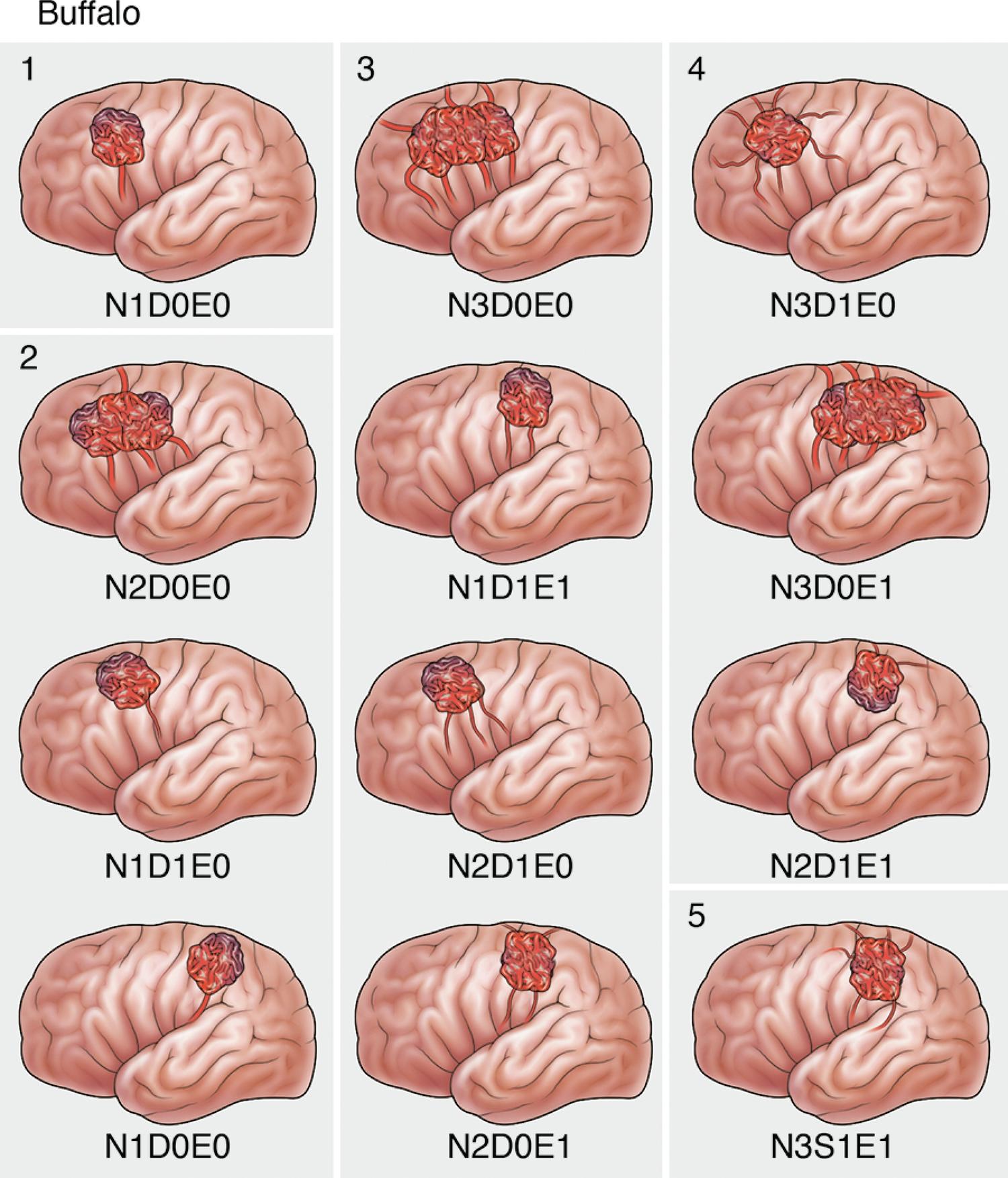 Fig. 15.1, Comparison of Buffalo and Spetzler-Martin grading systems. (Left) The Buffalo system takes into account the following features: number of arterial pedicles (N), diameter of those pedicles (D), and eloquent location (E). This schematic representation of supratentorial AVMs provides examples of different AVM types and the grades (1–5) determined by summing the points for each graded feature. A higher complication incidence would be expected for patients with a higher score. (Right) The Spetzler-Martin system takes into account the features of venous drainage (V), size (S), and eloquence (E). 6 This schematic representation of supratentorial AVMs provides examples of different AVM types and the grades (1–5 [I–V]) determined by summing the points for each graded feature. A higher complication incidence would be expected for patients with a higher score.