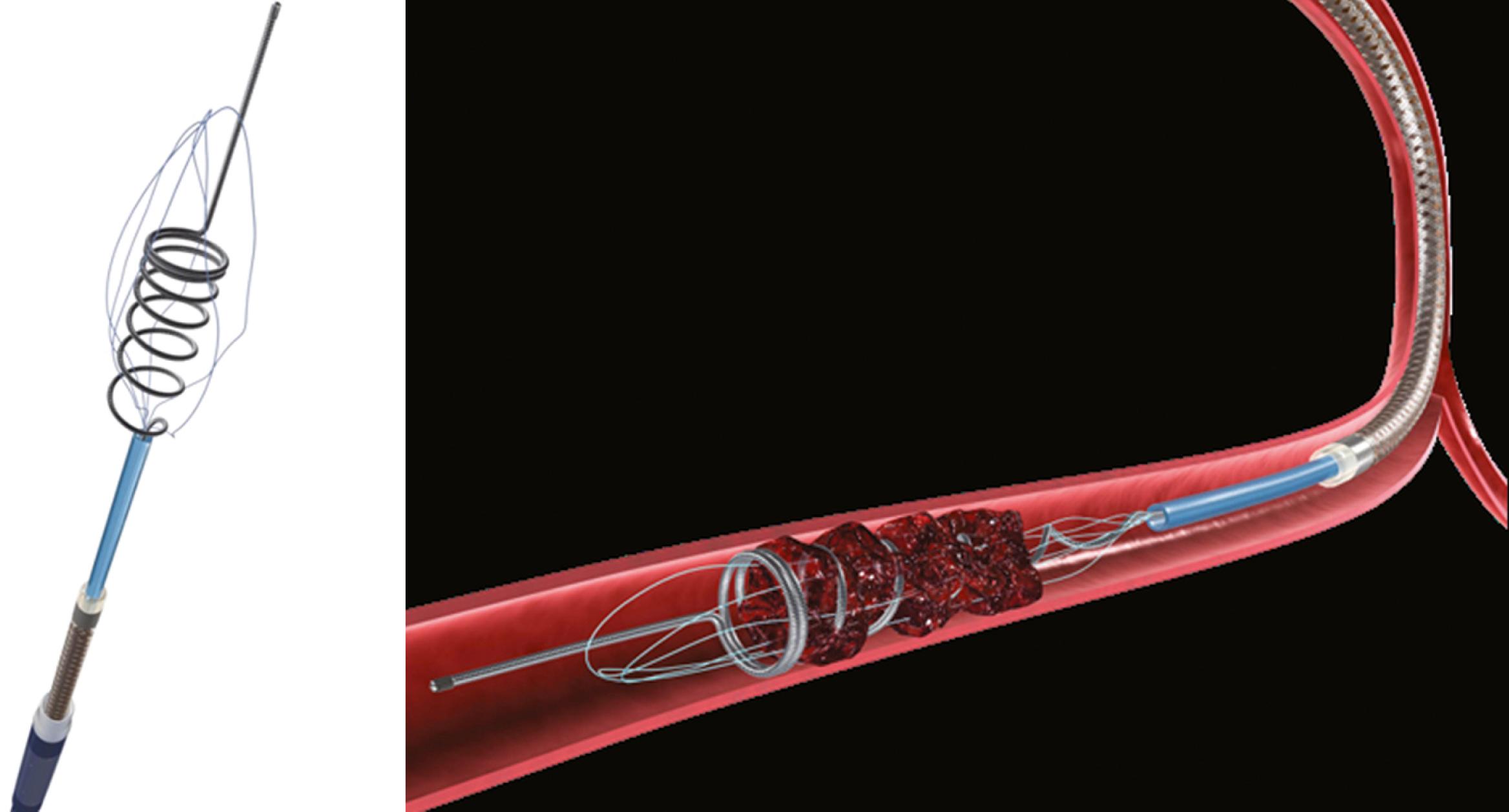 Fig. 54.1, Mechanical Embolus Removal in Cerebral Ischemia (MERCI) clot retrieval device (left) and diagram demonstrating mechanism of action (right) . Spiral loops and suture material are designed to engage the clot and mechanically remove it from the vessel.