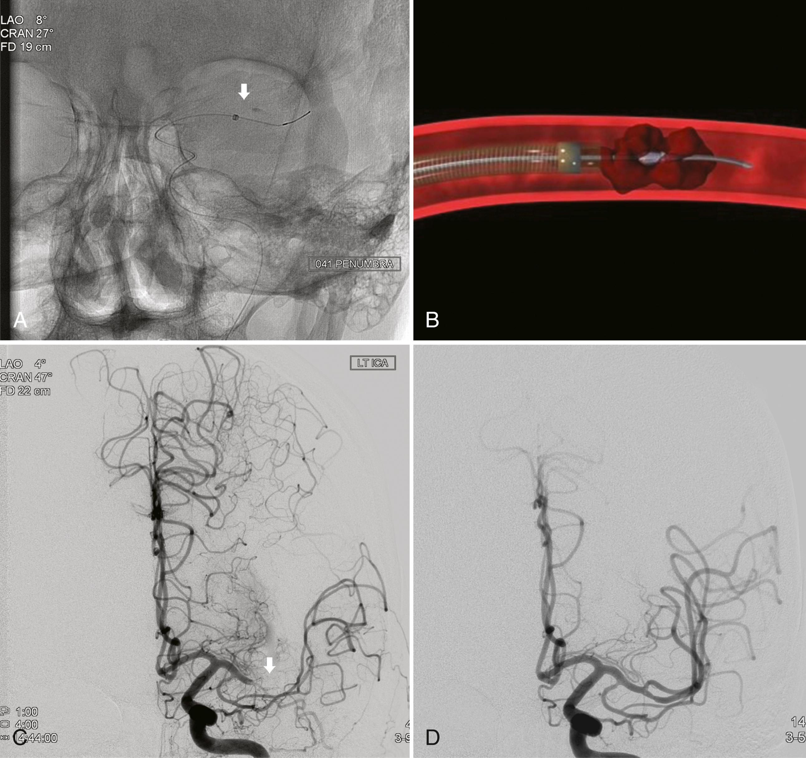 Fig. 54.3, An anteroposterior view shows a Penumbra aspiration catheter positioned within the left middle cerebral artery as indicated by the catheter tip (arrow) with Separator wire (A) . An artistic illustration depicts the process of clot removal with aspiration (B) . Angiogram images of a left middle cerebral artery occlusion before (C) and after thromboaspiration (D) show complete vessel recanalization.