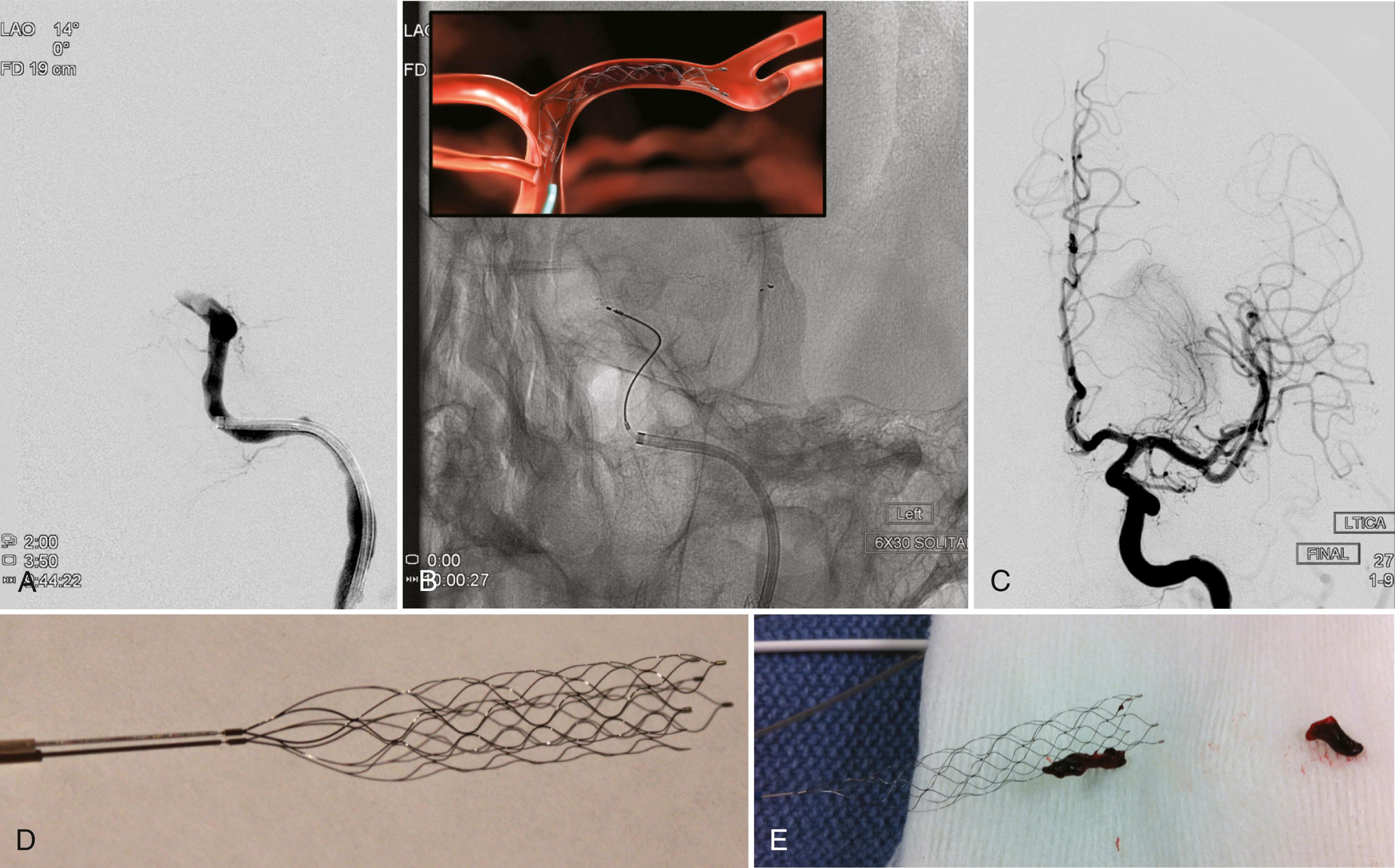 Fig. 54.4, A left internal carotid artery angiogram shows complete occlusion of the terminal segment which extends into the left middle cerebral artery (A) . Fluoroscopy imaging shows a guide sheath positioned in the left internal carotid artery, a coaxially introduced microcatheter extending into the internal carotid artery terminal segment, and a retrievable stent design thrombectomy device (Solitaire FR) deployed within the left middle cerebral artery (B) . An artistic depiction of the device is shown in the inset. After mechanical clot removal, complete revascularization of the left internal carotid artery and middle cerebral artery is observed on an angiogram (C) . The Solitaire FR is an example of a retrievable stent design thrombectomy device (D) . Thrombus can be observed adherent to the device after thrombectomy (E) .