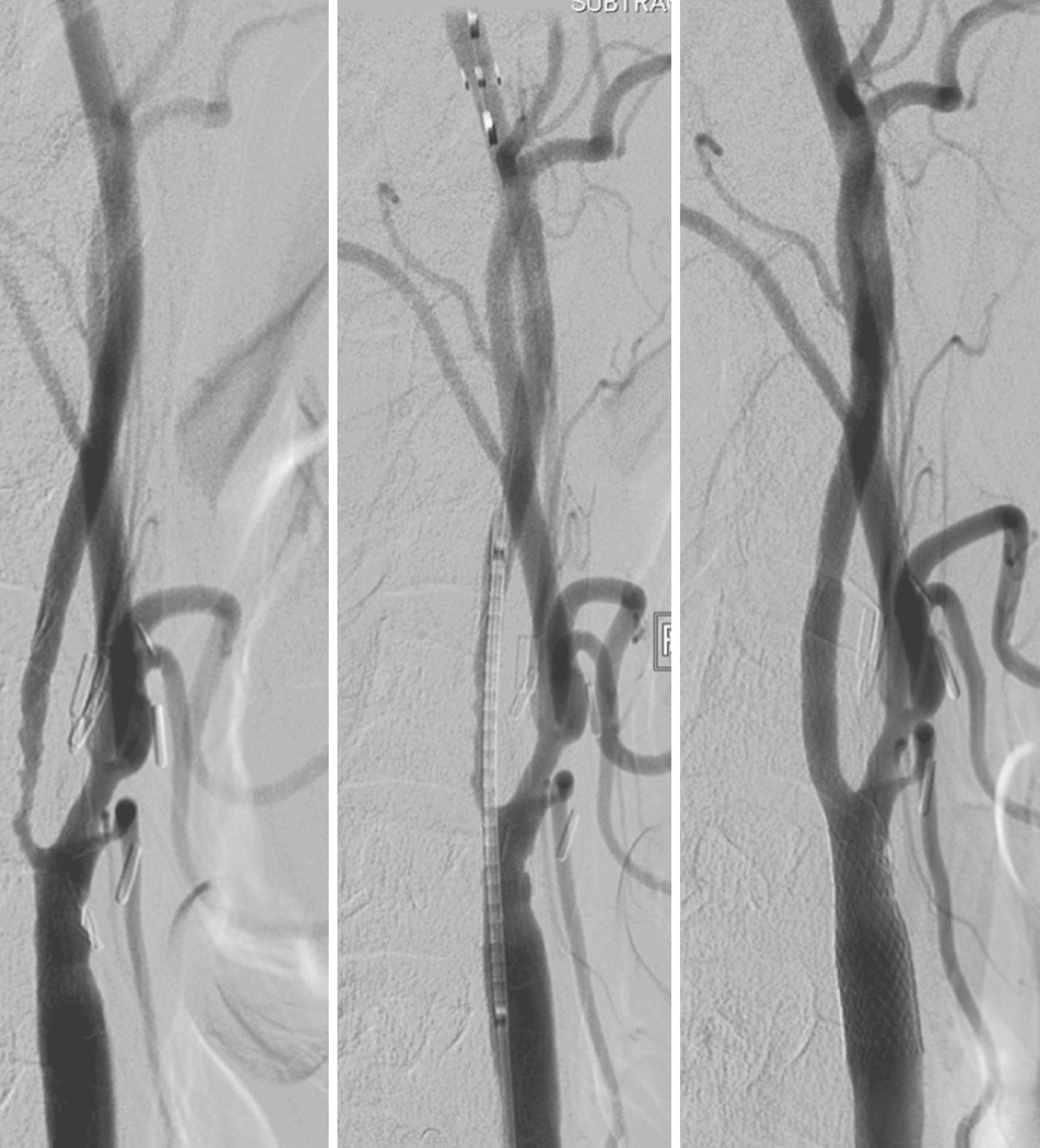 Fig. 54.6, Lateral angiogram demonstrating critical proximal internal carotid artery stenosis (left) . Embolic protection device is opened in distal cervical internal carotid artery (top of picture, middle ). Following balloon dilatation, stent is positioned across stenotic segment (middle) . Lateral angiogram showing stent deployed in distal common and proximal internal carotid artery, with minimal residual stenosis (right) .