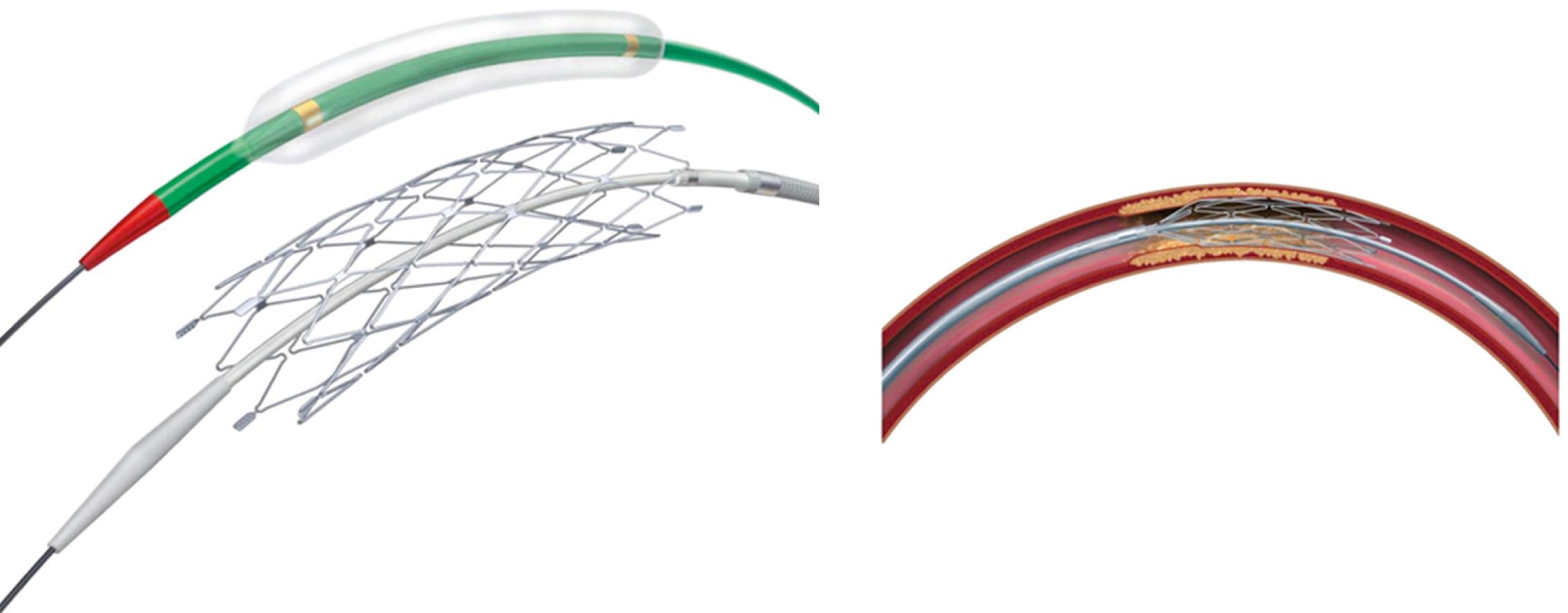 Fig. 54.7, Gateway balloon and Wingspan stent (left) . Stent deployment across an intracranial stenotic lesion with resultant opening of vessel lumen (right).