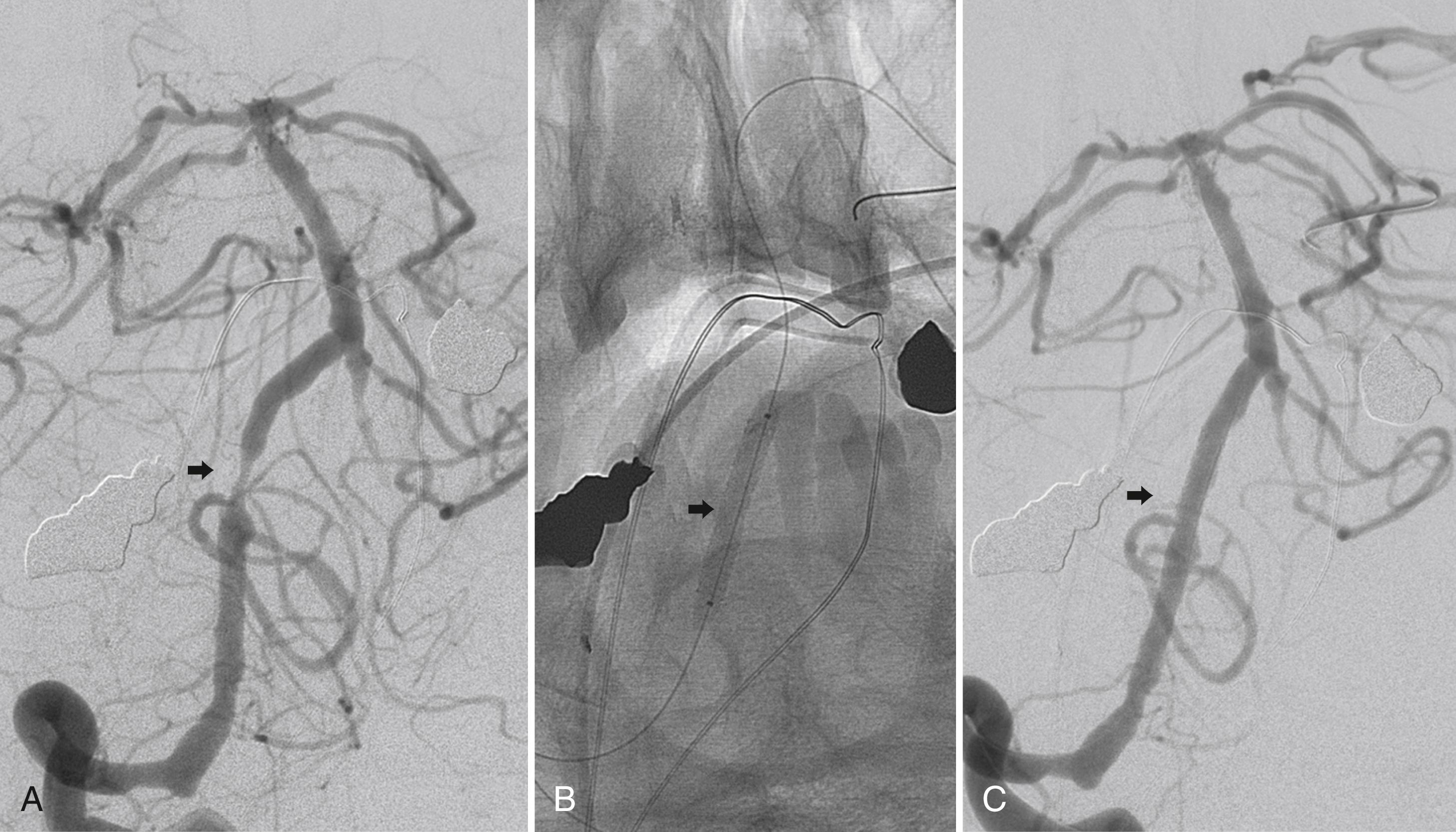 Fig. 54.8, In a patient with recurrent posterior circulation strokes, anteroposterior angiogram shows diffuse intracranial atherosclerotic disease and severe narrowing of a right vertebral artery intracranial segment (arrow) resulting in 70% stenosis and occlusion of the contralateral vertebral artery (A) . A balloon mounted intracranial stent was implanted (B) . Angiogram following angioplasty and stenting shows no residual stenosis (C) .