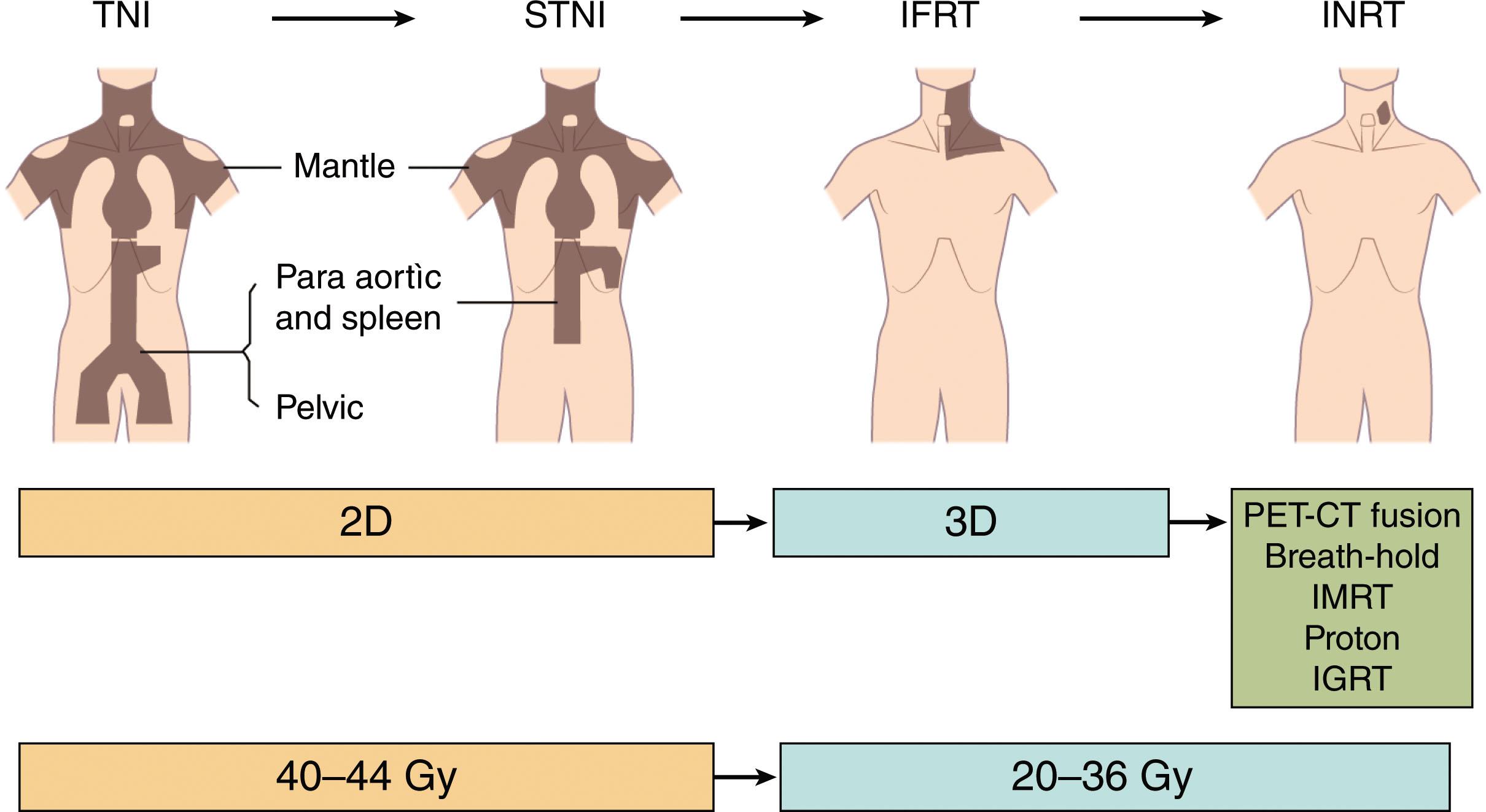 Figure 95.1, HISTORICAL EVOLUTION OF TREATMENT FIELDS IN HODGKIN LYMPHOMA.