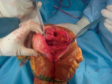 FIGURE 12.3, The bone defects are evident after removal of the implants at the time of revision.