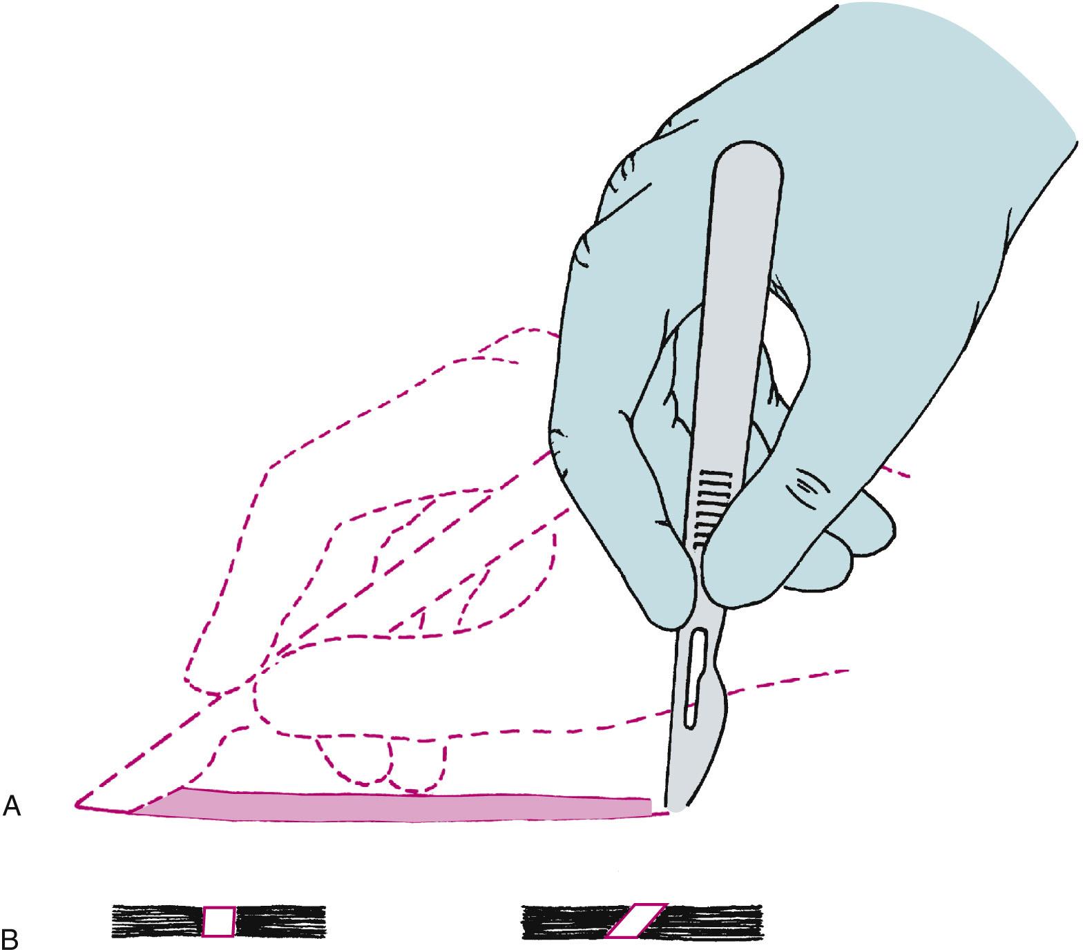 Fig. 3.1, (A) Proper method of making incision using No. 15 scalpel blade. Note the scalpel motion is made by moving the hand at the wrist and not by moving the entire forearm. (B) When creating a tissue layer that is to be sutured closed, the blade should be kept perpendicular to the tissue surface to create squared wound edges. Holding the blade at any angle other than 90 degrees to the tissue surface creates an oblique cut that is difficult to close properly and compromises blood supply to the wound edge.