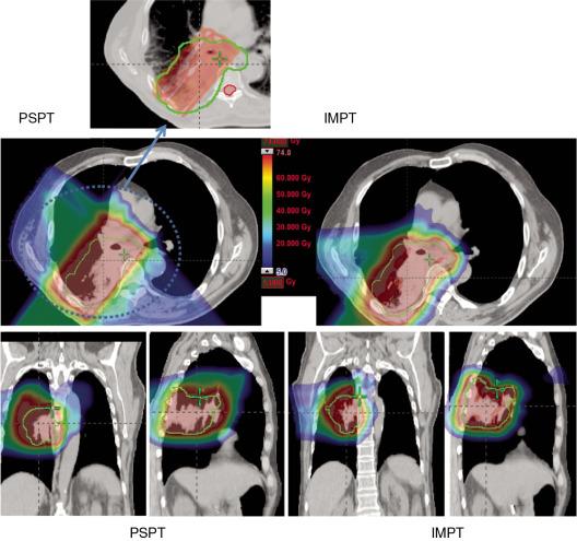 Fig. 5.1, Comparison between passive scatter proton therapy (PSPT) and intensity-modulated proton therapy (IMPT) for lung cancer. Dose distributions for the PSPT (left) and IMPT (right) plans are shown. Green lines delineate the PTV. An enlarged image of the target region for the PSPT is shown to indicate the inadequate dose coverage caused by aperture editing.