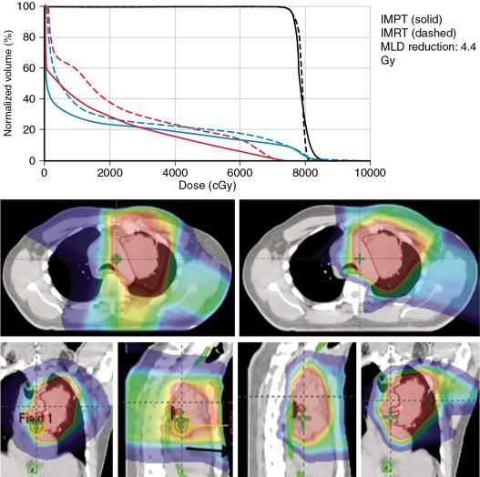 Fig. 5.2, The first patients treated using intensity-modulated proton therapy (IMPT) multiple-field optimization technology at MD Anderson Cancer Center. The comparison between the IMPT plan (right) and intensity-modulated radiation therapy (IMRT) plans (left) . MLD , Mean lung dose.