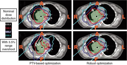 Fig. 5.3, Isodose contours of the dose distribution in the transverse plane of a lung cancer case: (A and B) planning target volume (PTV) –based plan; (C and D) robustly optimized plan; (A and C) with the nominal range; (B and D) with 3.5% higher than the nominal range. Green color wash: Clinical target volume (CTV); purple color wash, spinal cord.