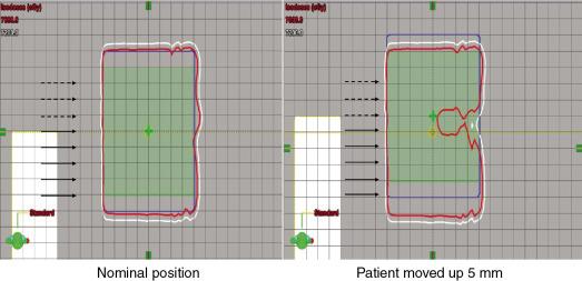 Fig. 5.4, Dose distribution symmetry broken under perturbation.