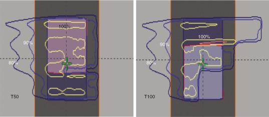 Fig. 5.5, Uncertainty caused by breathing motion: left, plan designed on the T50 phase of the computed tomography (CT) scan; right, same plan recalculated on the T0 phase of CT.