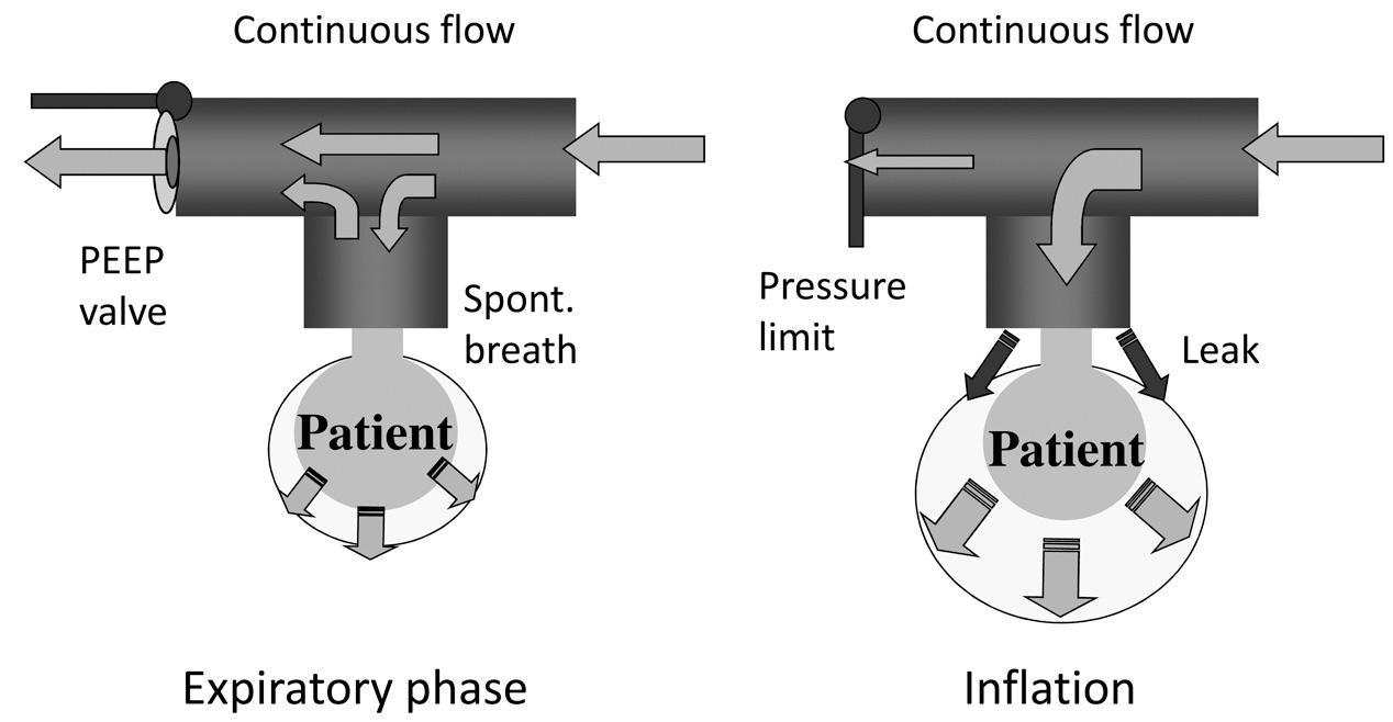 Fig. 10.2, Basic function of pressure-controlled ventilation is similar to a T-piece resuscitator. During the expiratory phase, the expiratory valve is open and there is continuous flow in the circuit. A PEEP valve maintains a distending pressure and the patient can breathe spontaneously from the circuit. When the expiratory valve closes, the circuit is pressurized and gas enters the lungs in proportion to the pressure in the circuit and the compliance of the lungs. Gas leakage around the uncuffed endotracheal tube is not a problem, as plenty of fresh gas is available to maintain inflation pressure.