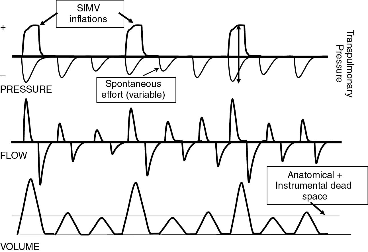 Fig. 10.4, Breathing pattern of a small infant on synchronized intermittent mandatory ventilation (SIMV). Standard airway pressure, flow, and volume curves are shown in the upper, middle, and lower panels, respectively. Spontaenous respiratory effort of the infant, which is not seen on the ventilator display, is added to the pressure waveform as a negative pressure deflection. Because of high resistance of small endotracheal tubes and weak respiratory effort of extremely preterm infants, the tidal volume of unsupported spontaneous breaths often fails to clear anatomic and instrumental dead space.