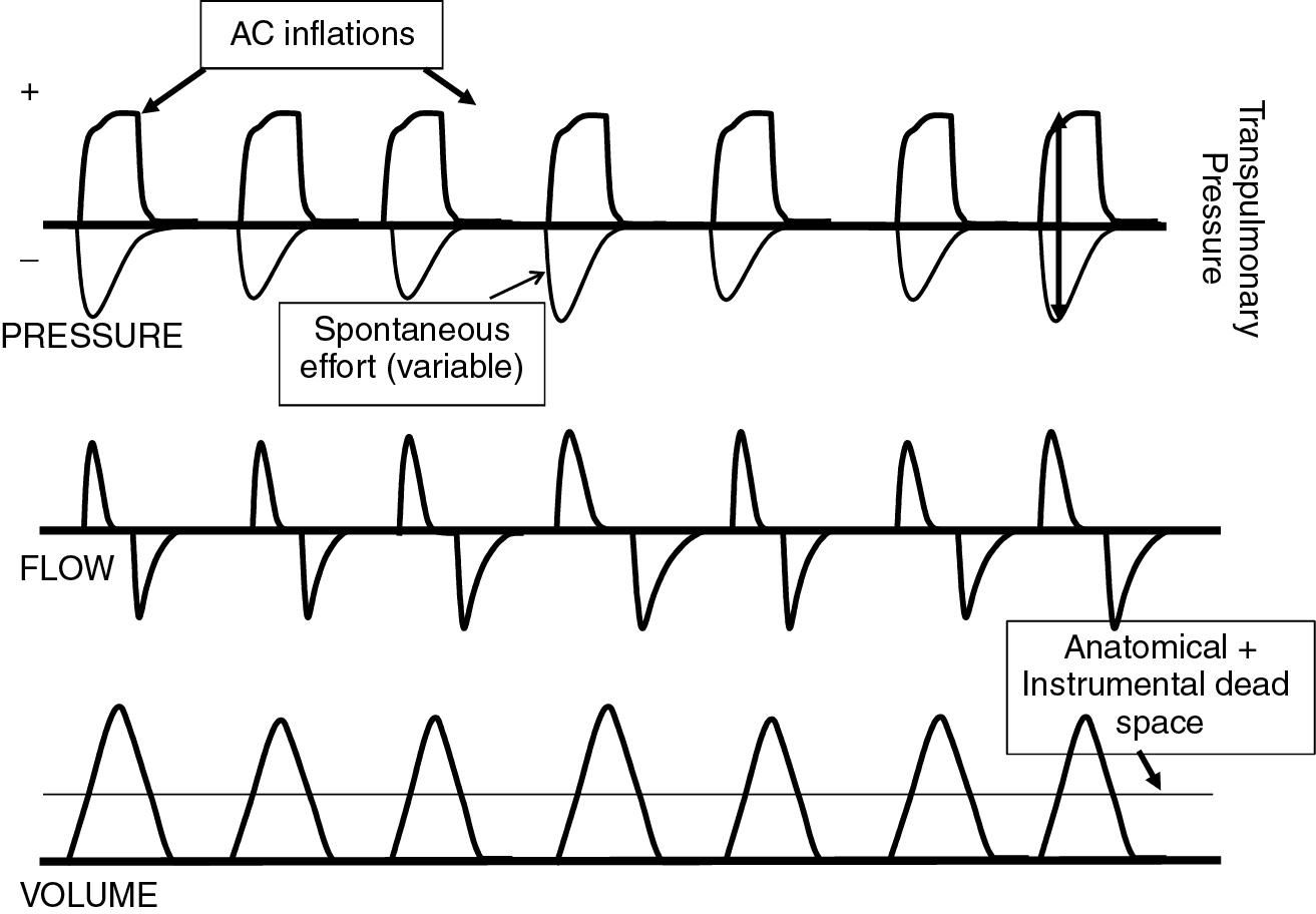 Fig. 10.5, Improved breathing pattern with assist control ventilation. Every breath is supported, thus easily clearing dead space volume. The tidal volume is more consistent and lower than with SIMV.