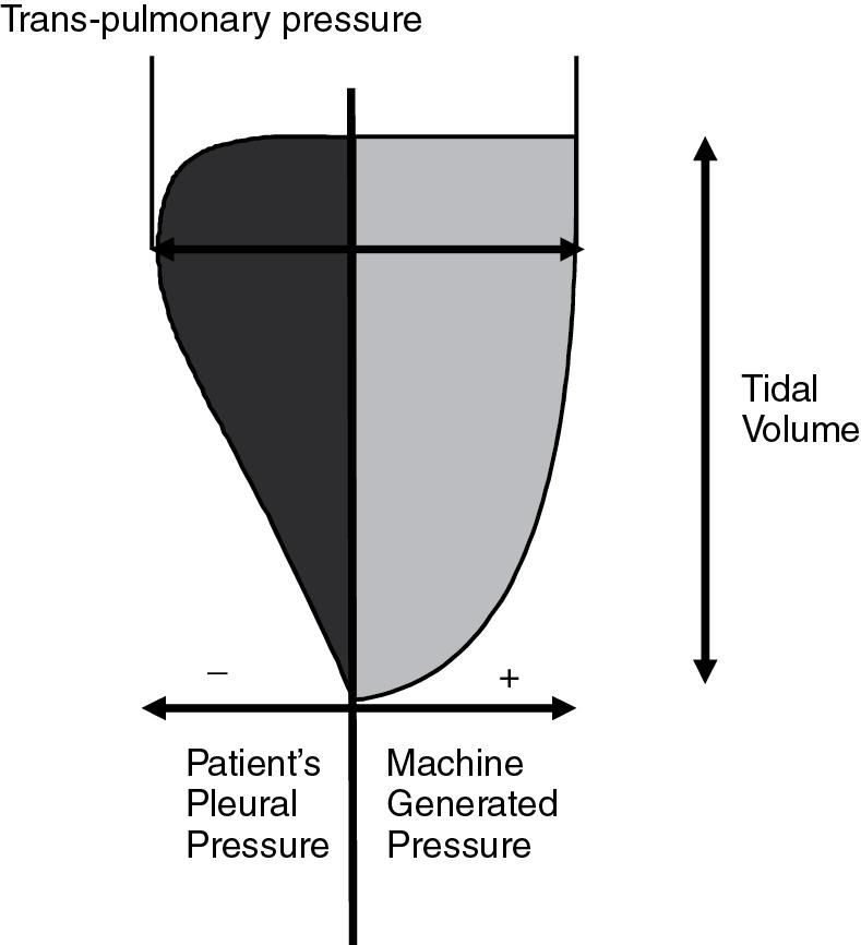 Fig. 10.6, With synchronized ventilation, the infant’s spontaneous inspiratory effort (dark shaded area) is additive to the positive pressure generated by the ventilator (light area). Together, this transpulmonary pressure results in the tidal volume that enters the patient’s lungs. The ventilator only measures and displays the machine-generated positive pressure. When ventilator inflation pressure is reduced, the infant gradually assumes a grater proportion of the transpulmonary pressure and therefore achieves respiratory muscle training during the weaning process.