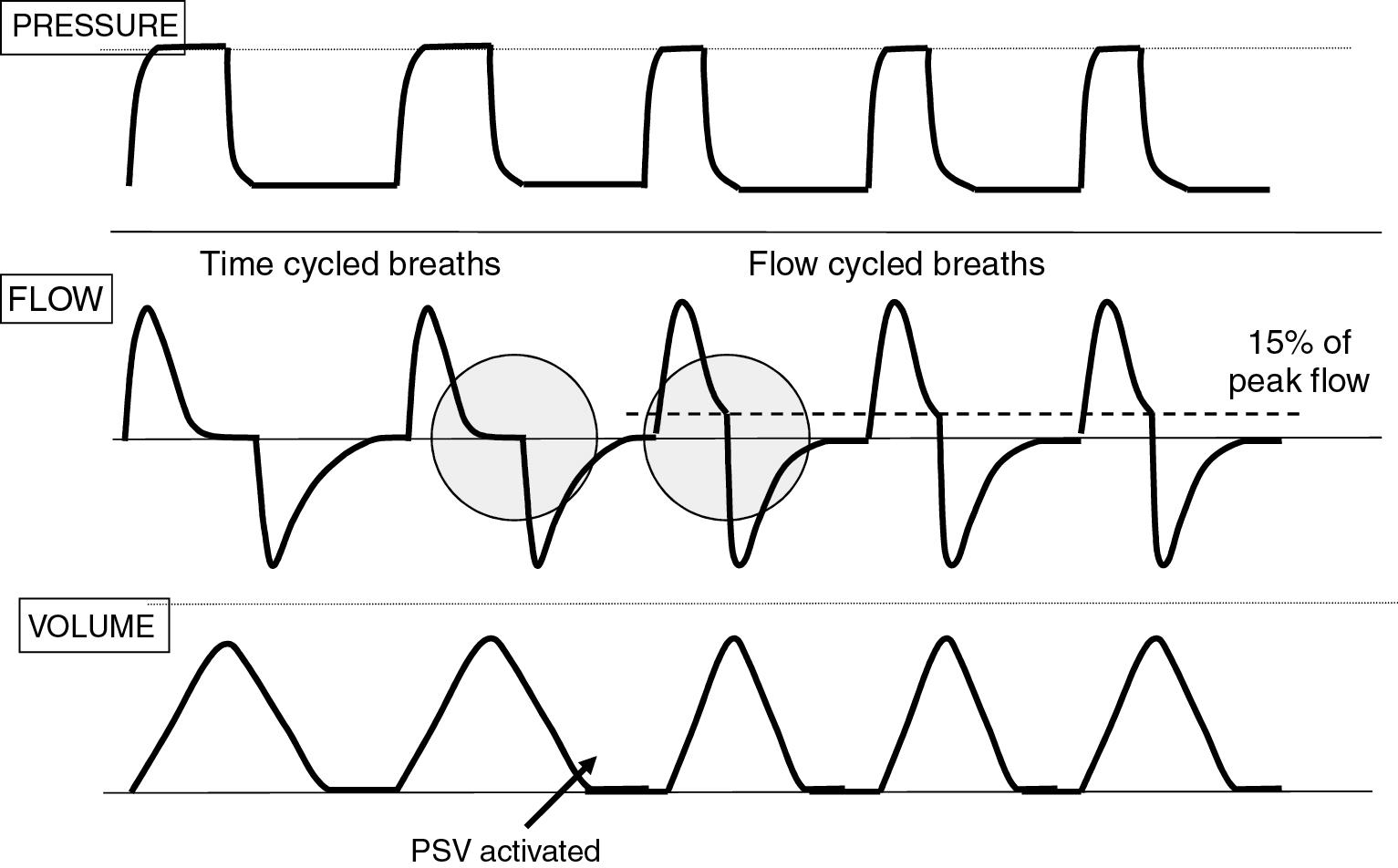 Fig. 10.7, The left side of the tracing shows time-cycled ventilation with a fixed inspiratory time, which typically results in an inspiratory hold—a period of time with no further gas flow but continued delivery of peak inflation pressure. The left side shows flow cycling, which means the ventilator cycles into exhalation once inspiratory flow drops to a set proportion of peak flow, thus eliminating inspiratory hold. In this way, the inspiratory time is automatically adjusted in response to patient inspiratory effort and changing lung mechanics. This more natural breathing pattern results in more complete synchrony.