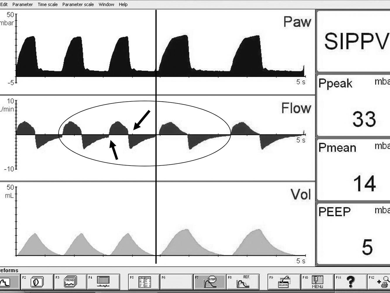 Fig. 10.8, Adequacy of inspiratory and expiratory time settings is best evaluated by examining the flow waveform. The left side of the panel shows that the set expiratory time is insufficient to allow complete exhalation because there is still active flow out of the lungs when the next inflation is triggered (arrow). Similarly, inspiratory flow has not returned to baseline when the ventilator cycles on (second arrow). The right side of the panel shows that with a slower ventilator rate (i.e., longer expiratory time) the expiratory flow has returned to zero before the next inflation and the inspiratory flow has also dropped to baseline before exhalation.