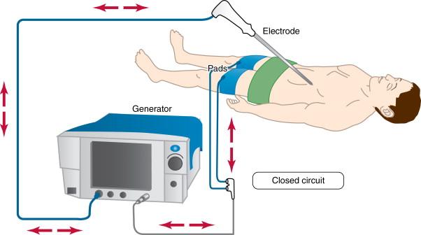 Figure 2-1, The thermal ablative effect is generated by the RF electrode, which acts as the cathode in an electrical circuit closed by attaching ground pads to the patient.