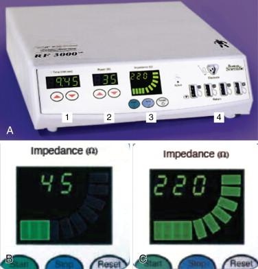 Figure 2-3, (A) Boston Scientific RF 3000 generator system: 1. Ablation time. 2. Power display. 3. Impedance display. 4. Pad-Guard current monitor for proper pad placement. (B) Initial tissue impedance is measured prior to application of RF energy and is typically within the range of 40–80 Ω, illuminating three bars on the front panel of the RF 3000 Generator. (C) Impedance rise is indicated by an increase in Ohms and a sequential illumination of the bars on the front panel, signaling cellular destruction and the completion of a thermal lesion.