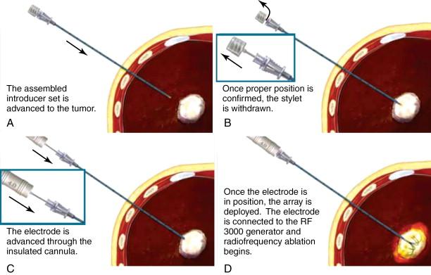 Figure 2-5, LeVeen CoAccess electrode system is a coaxial system. (A)–(D) show how to place the electrode. The electrode must be used in conjunction with the insulated cannula (C).