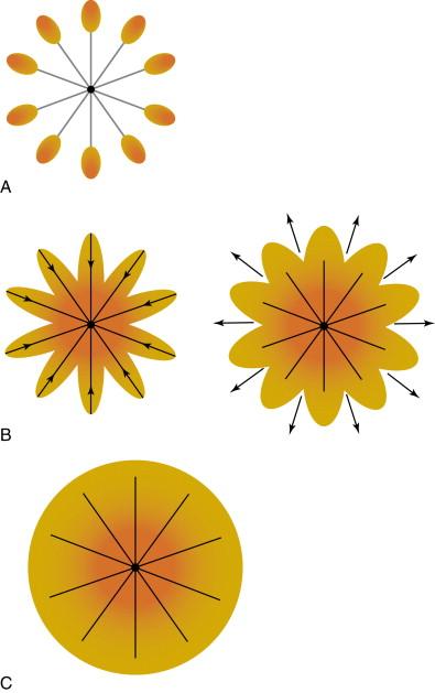 Figure 2-6, (A) The thermal lesion developed by the LeVeen Needle electrode begins at the tips of the array tines. The multiplicity of tines in the electrode allows the RF energy to shift away from any given tine as the adjacent tissue desiccates and increases in impedance. (B) As the tissue near the tips of the tines desiccates, the zone of ablation travels back along the tines toward the center of the array. The thermal lesion then moves outward and begins to fill in the gaps between the tines. (C) A complete thermal lesion is achieved once tissue desiccation has occurred throughout the target tissue. The RF 3000 Radiofrequency Generator is designed to receive feedback from the target tissue to reduce power and signal a complete thermal lesion.