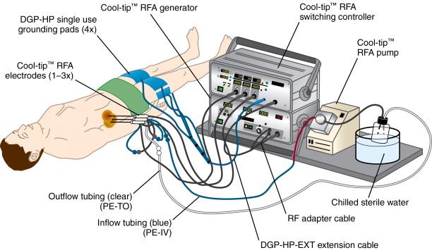 Figure 2-7, Covidien Cool-tip™ setup. Pads close the electrical current circuit. Chilled water pumped through electrodes.