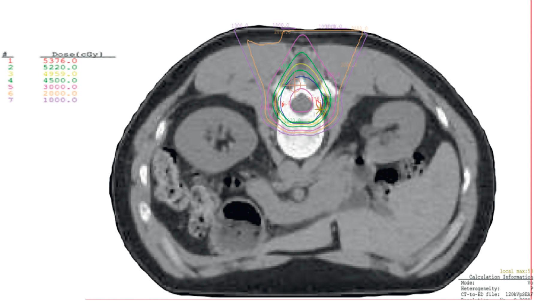 Figure 27.2, Axial proton treatment plan for a spinal myxopapillary ependymoma with sparing of the bone marrow and anterior-lying organs.