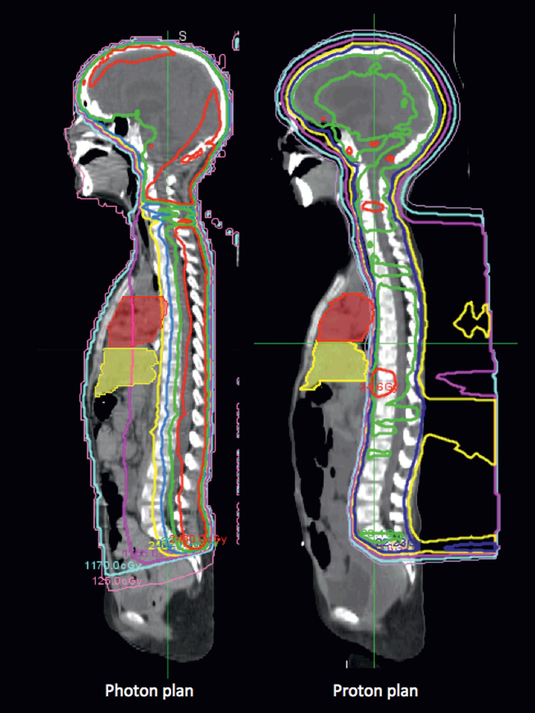 Figure 27.3, Comparison of photon and proton craniospinal radiation treatment plans for pediatric medulloblastoma. Both techniques use a single posterior beam, but the proton plan has significantly less exit dose.