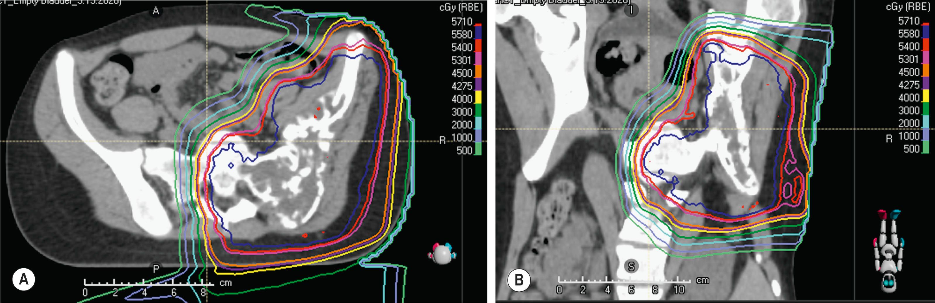 Figure 27.4, (A,B) A 13-year-old girl with a pelvic Ewing sarcoma treated to a definitive dose of 55.8 Gy in 31 fractions with concurrent chemotherapy. Proton therapy allowed for ptimal sparing of pelvic organs including a uterus max dose of 9.2 Gy, ipsilateral ovary mean dose of 14 Gy, and most importantly a contralateral ovary dose of <1 Gy, which should retain endocrine and fertility function.