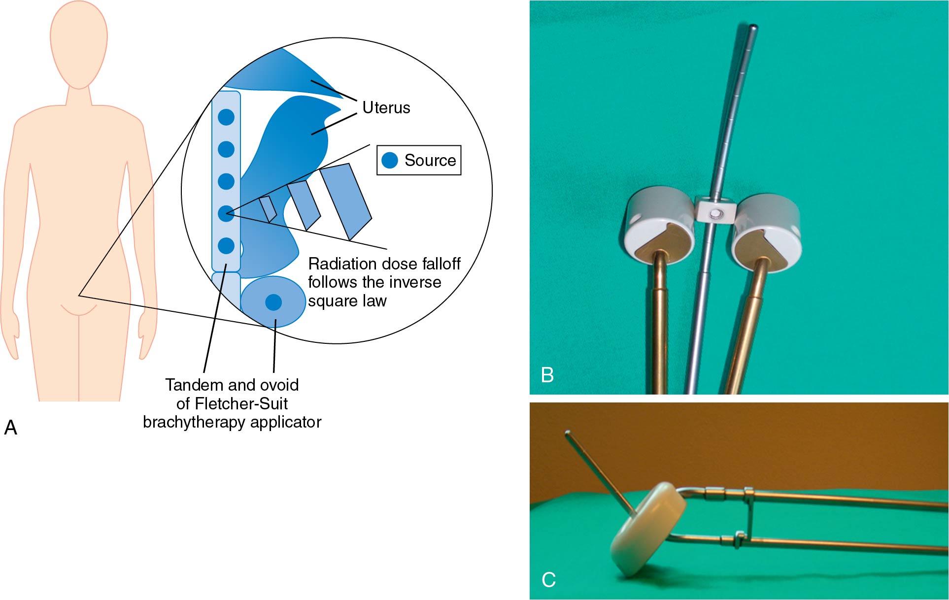 Fig. 28.6, Brachytherapy. For the treatment of gynecologic malignancies, brachytherapy usually consists of the placement of radiation sources (dark circles) in close proximity to the tumor (A). This can be accomplished by the intracavitary placement of hollow applicators such as the Fletcher-Suit applicator (inset) (B) or tandem and ring (C) placed within the uterine cavity and vaginal vault or by the interstitial placement of hollow needles through the tissues themselves. The radiation dose decreases as the square of the distance away from the radiation source.