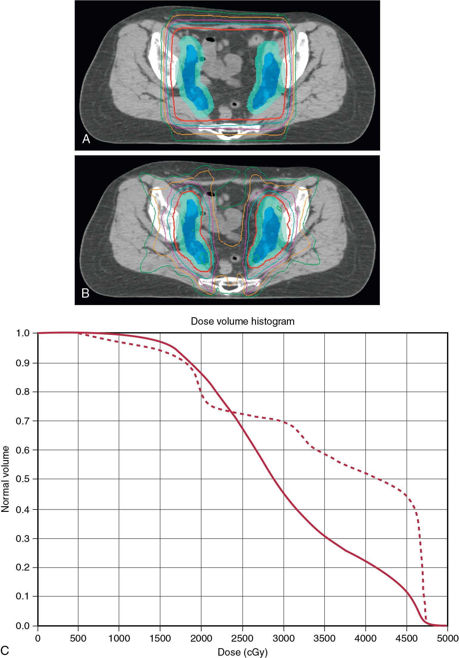 Fig. 28.7, Treatment plan. A, The distribution of dose with a standard three-dimensional (3D) plan. The red line is the 45 Gy isodose line and, as shown, everything within the red line gets 45 Gy, including all the bowel. B, The distribution of dose using intensity-modulated radiotherapy (IMRT). Again, the red line is the 45 Gy isodose line, and what can clearly be seen is the sparing of bowel using IMRT. C, The dose to bowel—the dotted line is the bowel dose using the 3D plan and the solid line is the bowel dose using the IMRT plan. As shown, with IMRT, the bowel gets a less high dose compared with the 3D plan.