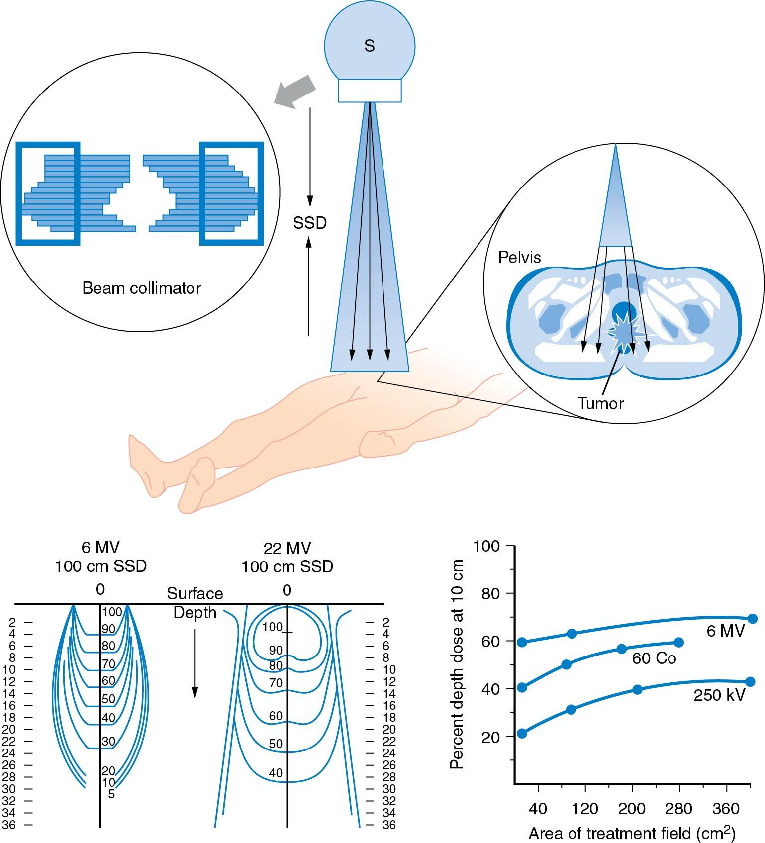 Fig. 28.8, Teletherapy. Conventional external beam radiotherapy is the delivery of radiation dose to tissues at a distance (SSD) away from the radiation source (S). As the beam emerges from the treatment machine, the beam diverges and can be shaped by high-Z material leaflets of a beam collimator (top) or custom blocks. As the treatment beam hits the patient, photon interactions occur, producing ionization events (inset). Energy deposition within tissue creates isodose curves. Isodose curves and depth-dose distributions for 6- and 22-MV photons are shown (bottom left). Note that the higher-energy machine delivers radiation to a greater depth for the same surface dose, resulting in skin sparing. As treatment field size varies, the dose delivered at a specified depth varies (bottom right).