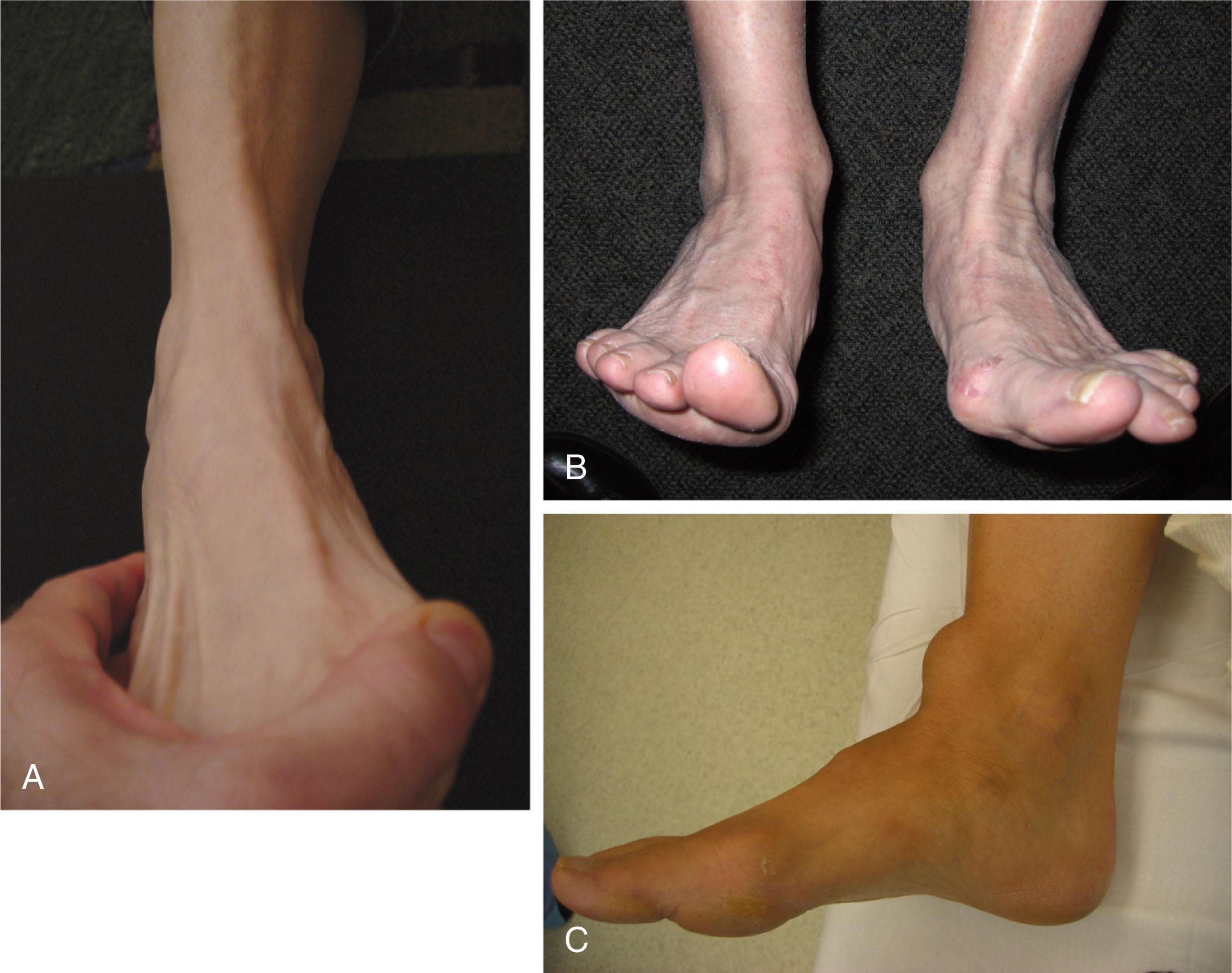 Fig. 2-11, A , Normal anterior tibial tendon. B , Rupture of anterior tibial tendon noted on left (right foot). C , Rupture and contraction leaves a mass on the anterior ankle.