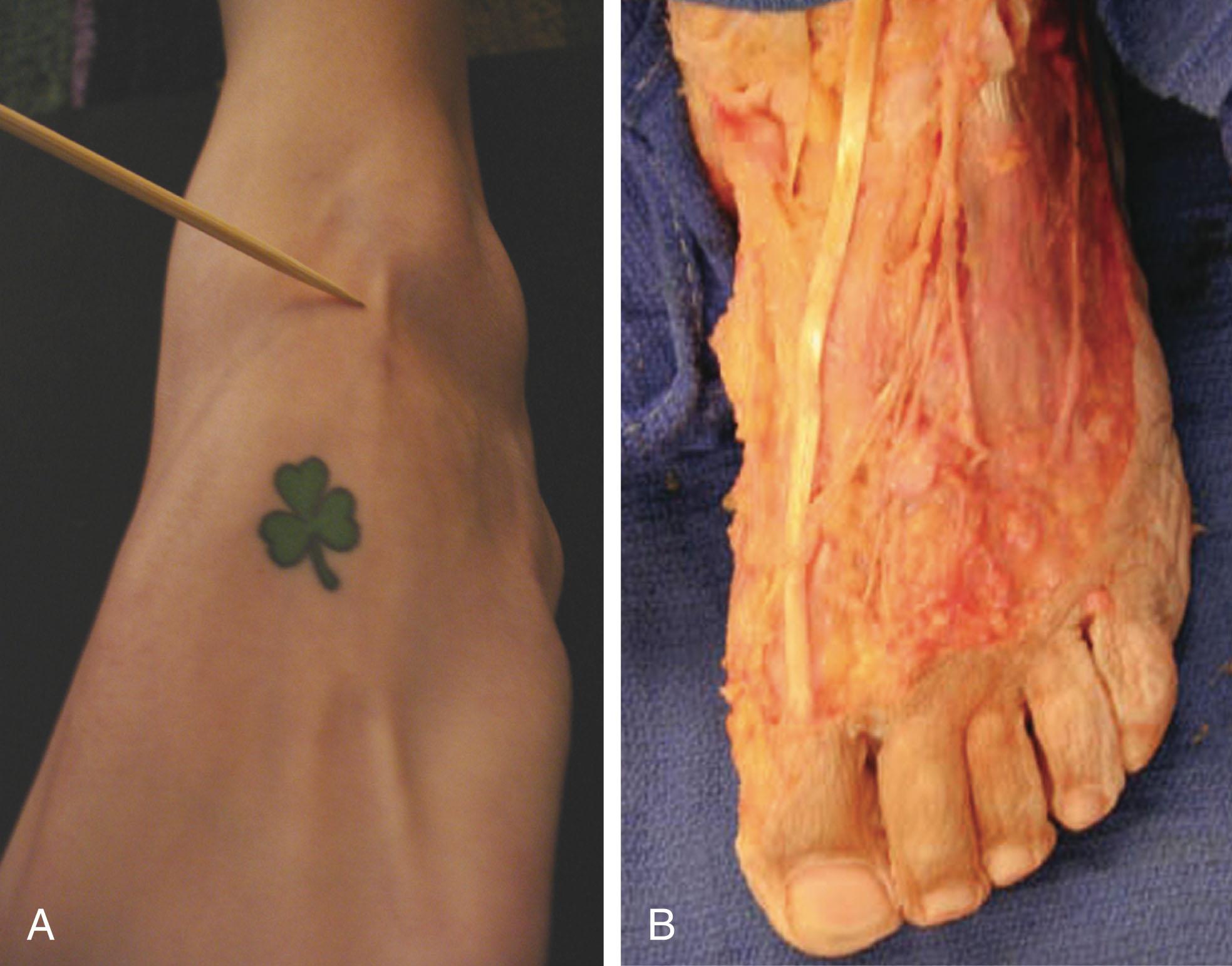 Fig. 2-12, Superficial peroneal nerves. A , Superficial anatomy. B , Anatomic dissection demonstrating superficial peroneal nerve branches.