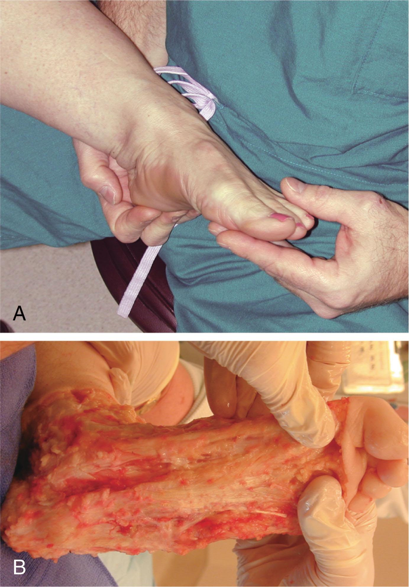 Fig. 2-14, Plantar fascia. A , Clinical examination of plantar fascia. B , Anatomic dissection demonstrating the plantar fascia.