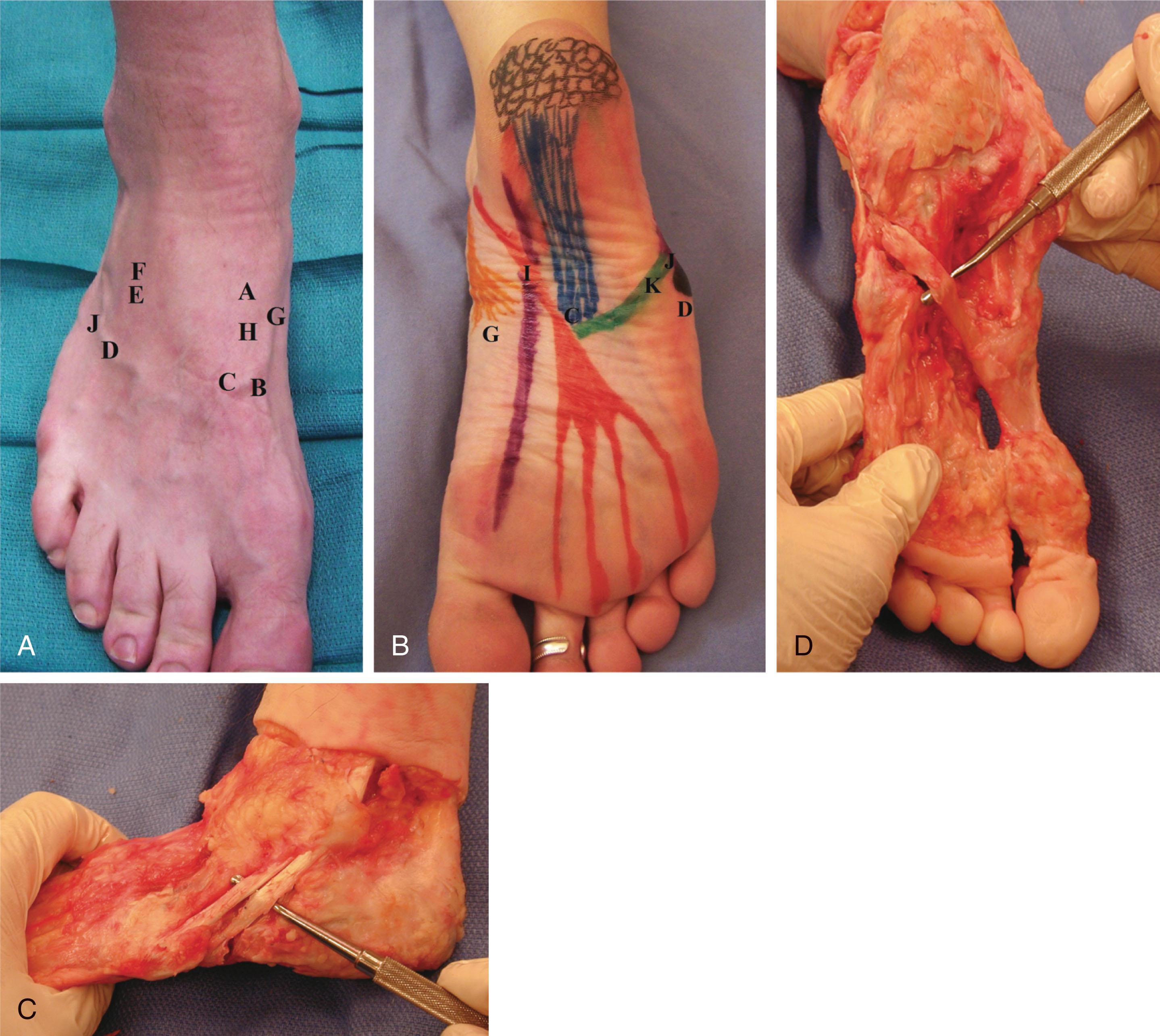 Fig. 2-15, Midfoot. A , Dorsal view. A , Talonavicular joint; B , first tarsometatarsal joint; C , second metatarsal base; D , base of the fifth metatarsal; E , calcaneocuboid joint; F , anterior process of the calcaneus; G , insertion of the posterior tibialis; H , insertion of the anterior tibialis; J , peroneus brevis insertion. B , Plantar view. D , base of the fifth metatarsal; G , insertion of the posterior tibialis; I , master knot of Henry; J , peroneus brevis insertion; K , cuboid tunnel. C , Anatomic specimen demonstrating peroneus longus and brevis. D , Plantar view of peroneus longus insertion.