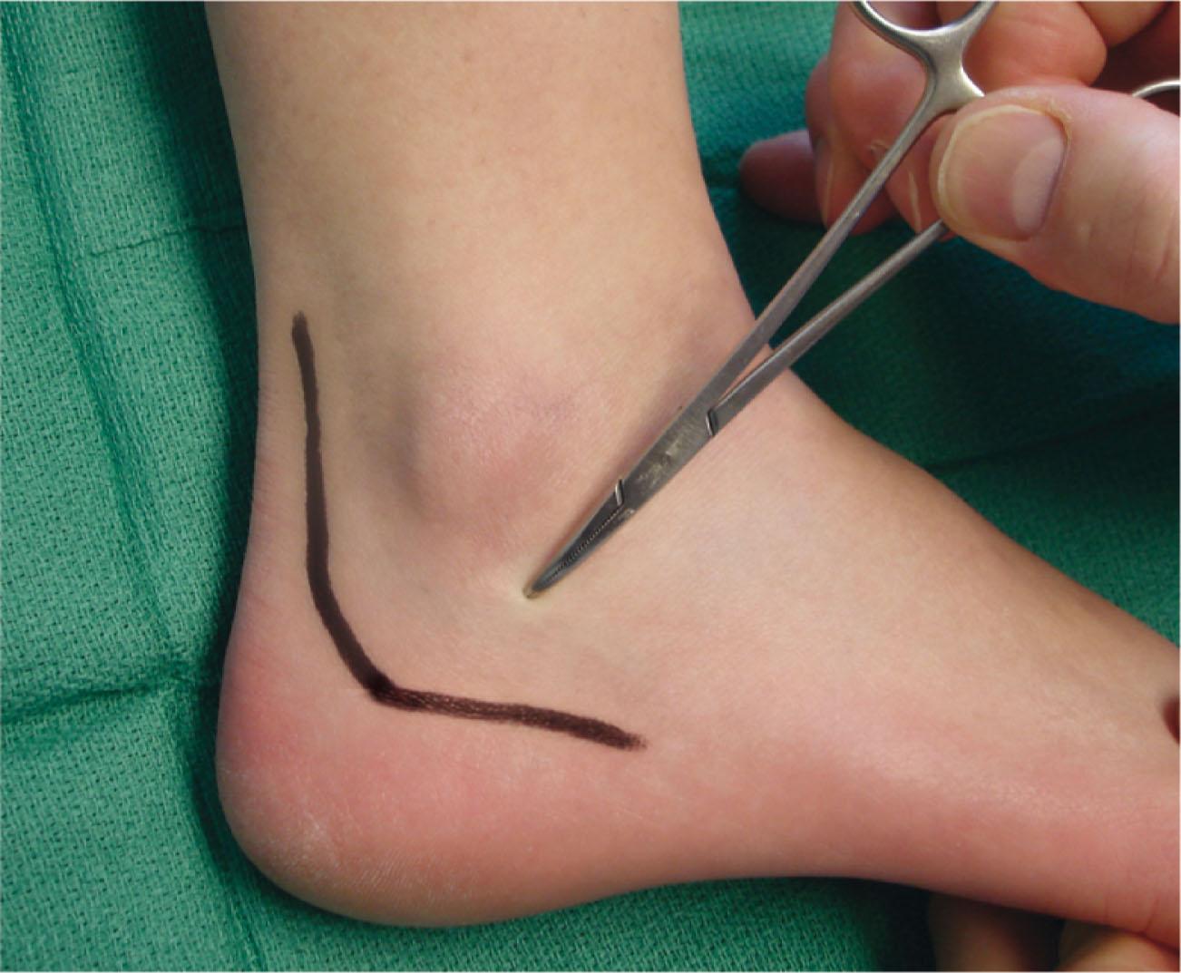 Fig. 2-2, Sural nerve, surface anatomy.