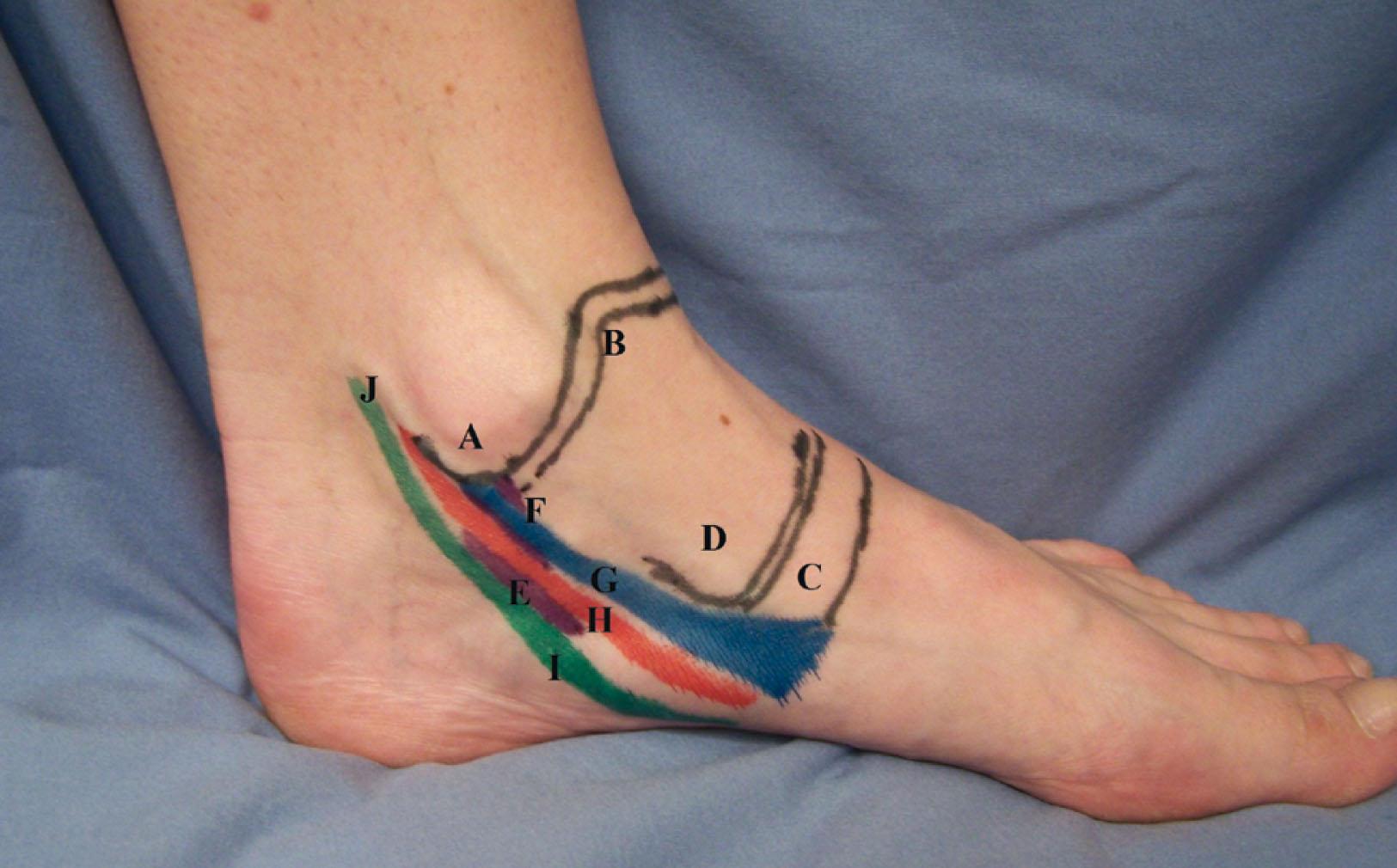 Fig. 2-4, Medial ankle and hindfoot topography, direct medial view. A , Tip of the medial malleolus; B , anterior medial tibiotalar joint line; C , navicular bone; D , the talar head; E , sustentaculum tali; F , superficial deltoid ligament; G , posterior tibial tendon; H , flexor digitorum longus; I , flexor hallucis longus; J , pulse of the posterior tibial artery.